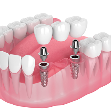 Illustration of two dental implants with a bridge