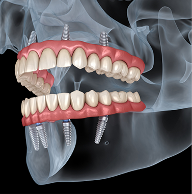 Illustration of a person with implant dentures replacing all of their teeth