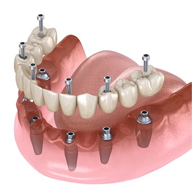 Illustration of multiple dental implants with crowns being placed in the lower jaw