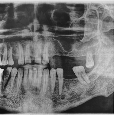 X-ray of a person with several missing teeth and drifted remaining teeth