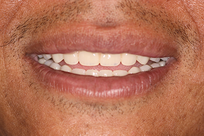 Patient's flawlessly repaired and replaced teeth