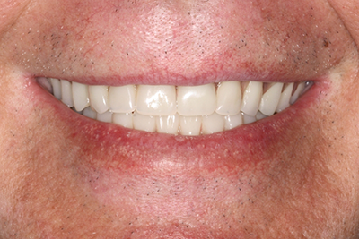 Patient's flawlessly repaired and replaced teeth