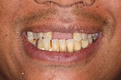 Patient's severely damaged teeth prior to treatment