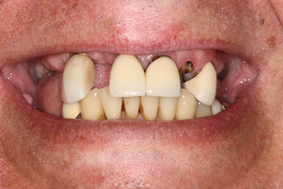 Patient's severely damaged teeth prior to treatment