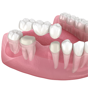 Illustration of a dental bridge replacing a missing tooth