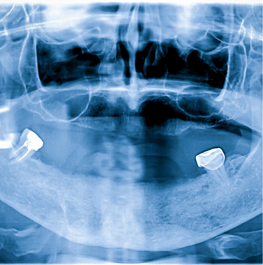 X-ray of a dental patient with only a few teeth left