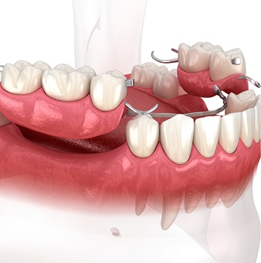 Illustrated partial denture replacing several missing teeth
