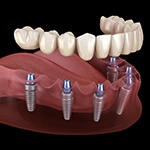 Implant dentures in Bellingham