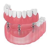 Diagram of implant-retained dentures in Bellingham