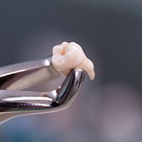 a tooth held by special forceps after a tooth extraction