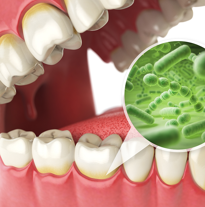 Illustration of a mouth infected with gum disease
