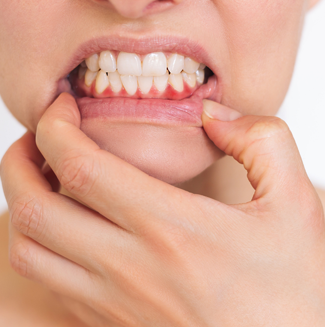 Close up of a person revealing their red gums