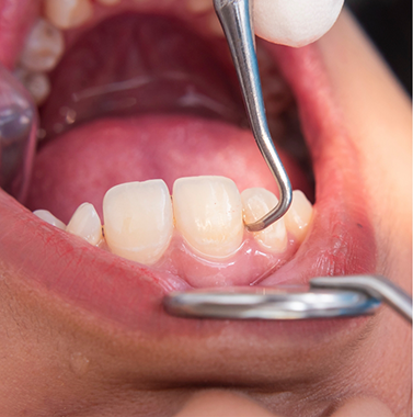 Close up of a dental patient getting scaling and root planing