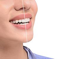 Woman’s smile before and after gum recontouring treatment