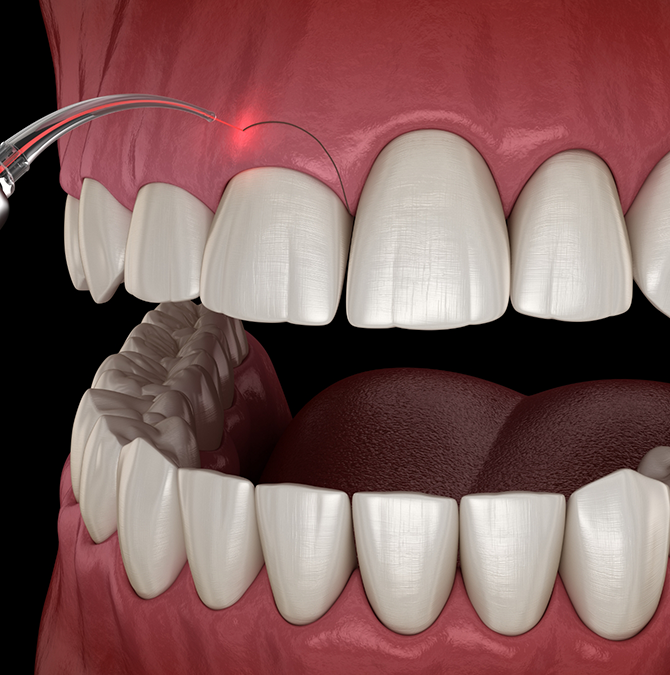 Illustration of a gummy smile being corrected with a dental laser