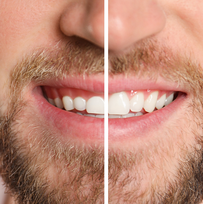Close up of a man smiling before and after gum recontouring