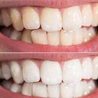 Before and after teeth whitening in Bellingham, WA 