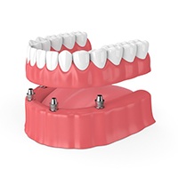 model of an implant denture on the lower arch 