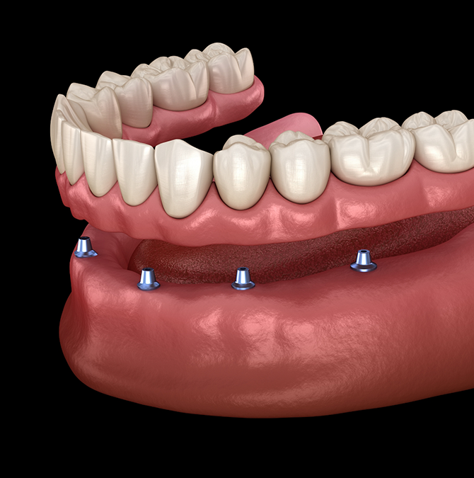 Illustration of an implant denture being placed on the lower arch