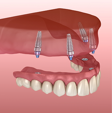 Illustration of an implant denture on the upper arch