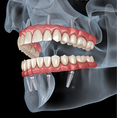 Illustration of a person with implant dentures on both arches