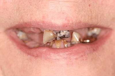Patient's severely damaged teeth prior to treatment