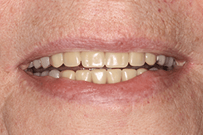 Patient's flawlessly repaired and replaced teeth