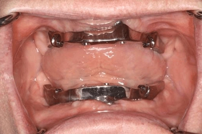 Closeup of extensive dental damage and decay