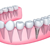 Model of a single dental implant in Bellingham, WA