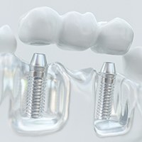 Close-up of model of dental implant bridge in Bellingham, WA