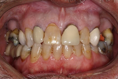 Patient's severely damaged teeth prior to treatment