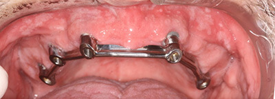 Closeup of gums following dental implant placement