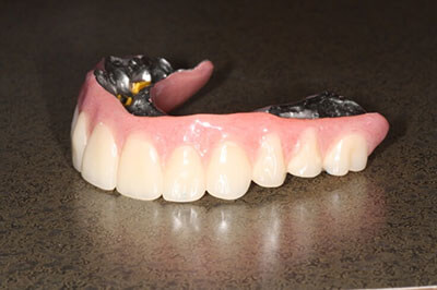 The dental implant denture prior to placement