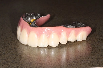 The dental implant denture prior to placement