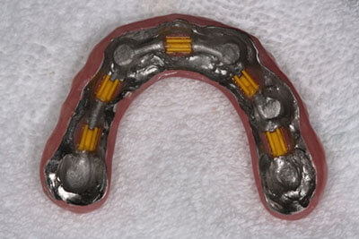 View of the inside of the dental implant denture