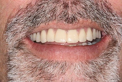 Patient's flawlessly repaired and replaced teeth