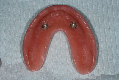 Inside of denture with implant attachements