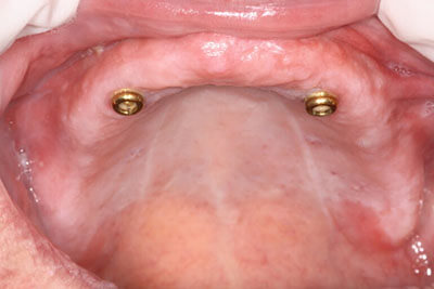 Gums with implant posts and abutments