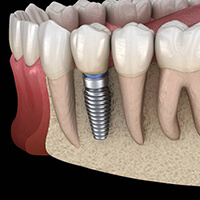 dental implant in Bellingham in the lower jaw 