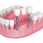 two dental implants supporting a dental bridge