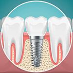 dental implant post in the jawbone 