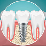 dental implant post in the jawbone 