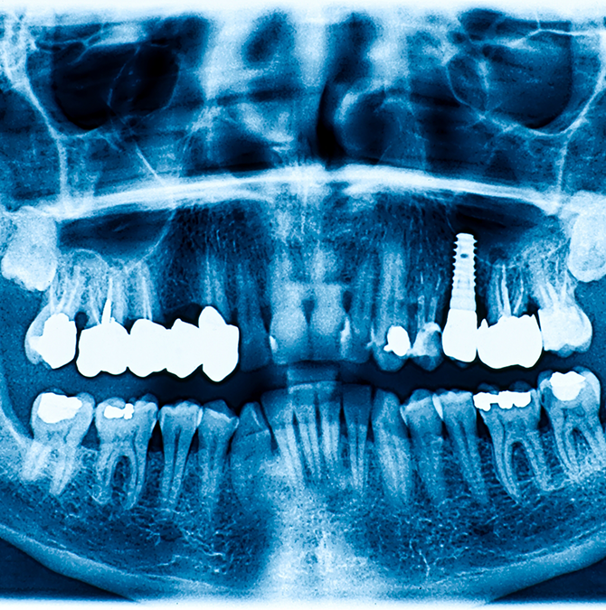 X-ray of a dental patient with a dental implant