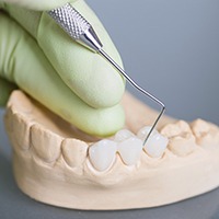 Model of teeth with fixed bridge restoration