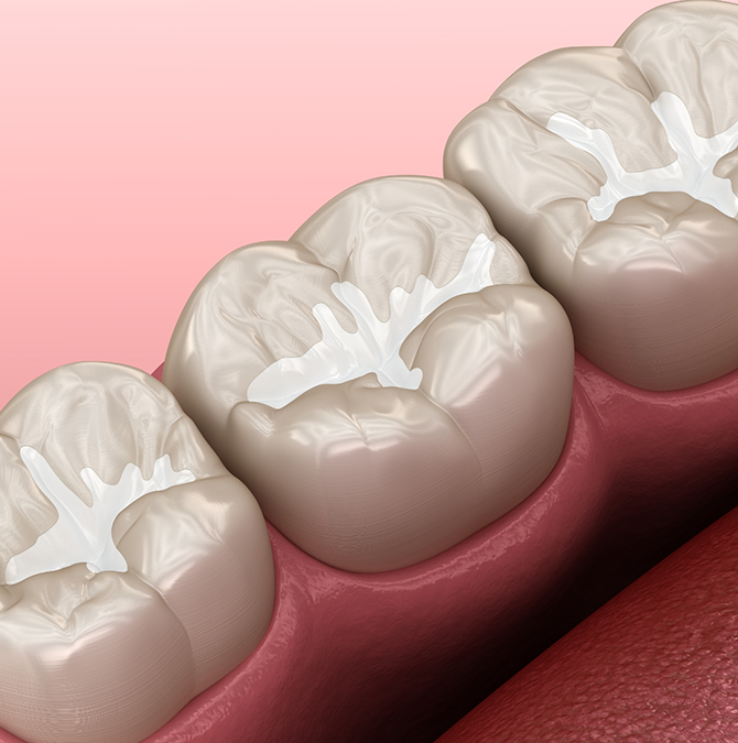 Illustration of teeth with white fillings