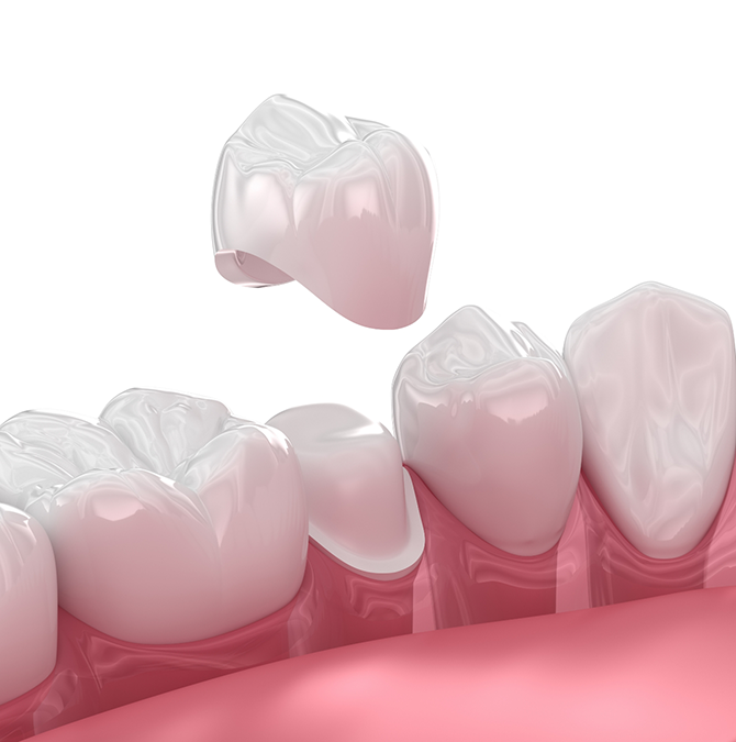 Illustration of a dental crown fitting over a tooth