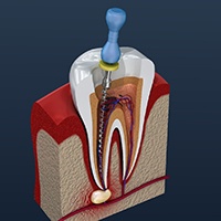 An illustration of the root canal process in Bellingham, WA