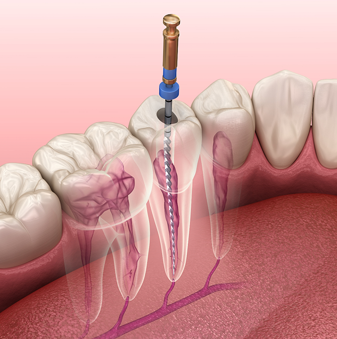 Illustration of root canal treatment being performed on a tooth