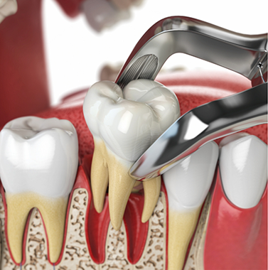 Illustration of a tooth being extracted