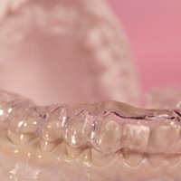 Customized oral appliance on model teeth